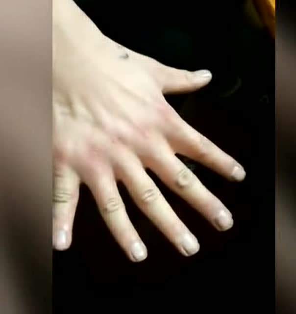 六个手指头，六个手指头能割掉吗