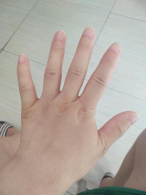 六个手指头，六个手指头能割掉吗