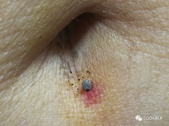 蜱虫咬人后的伤口图，被蜱虫咬后多久没事就安全了